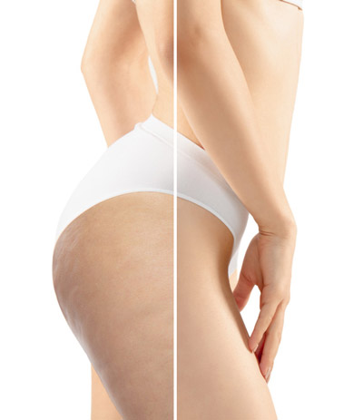 soins corps dermo esthétique contre le relâchement cutanée