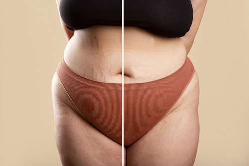 soins corps Vergetures et marques dermo- esthétique Bouc Bel Air région Aix en Provence